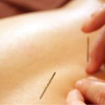 Acupuncture Melbourne