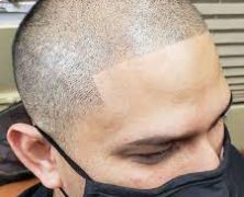 Scalp Micropigmentation Melbourne are Highly Skilled and Experienced