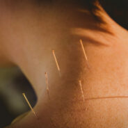 Relieving Pain Naturally: The Healing Power of Acupuncture
