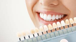 Teeth whitening